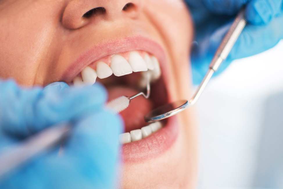 How Invisalign Influences Speech Patterns and Adapting to Clear Aligners in Daily Life